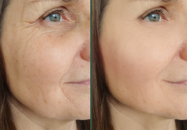 cheek lift threads before and after