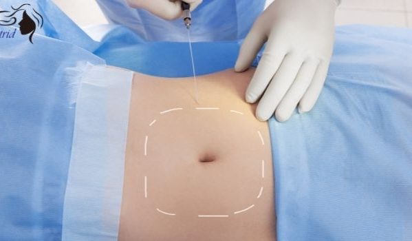 Abdominal Thread Lift