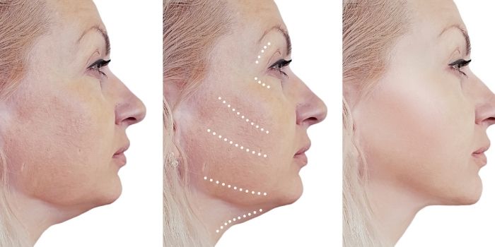 Pros and Cons of Surgical and Nonsurgical Facelifts