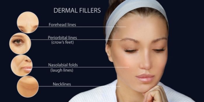 Dermal Fillers are the Best Non-surgical Facelifts