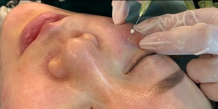 How does an Eye Thread Lift Work with Eye threads