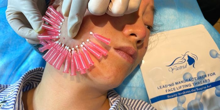 What You Should Not Do After PDO Thread Lift