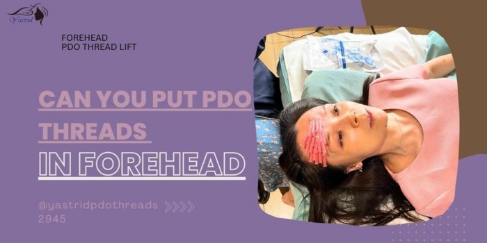 Can You Put PDO Threads in Forehead