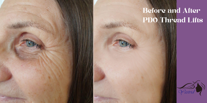 Before and After PDO Thread Lifts