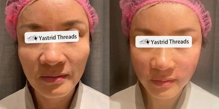 Two weeks after Yastrid PDO thread lift