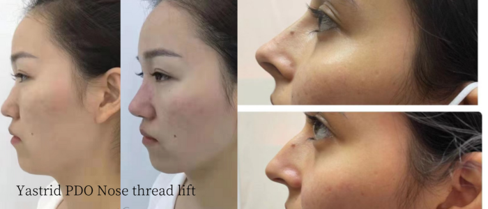 how long does nose thread lift last 1