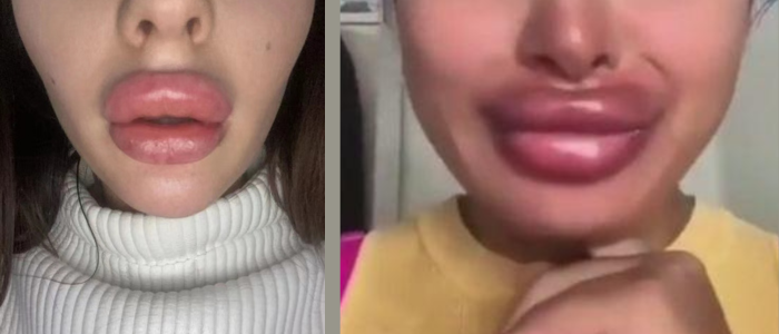 side effects of lip injections