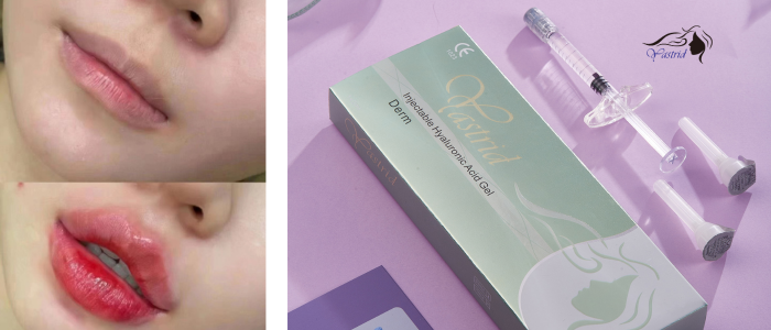 Case Six: Lip Injections Before And After Pictures: