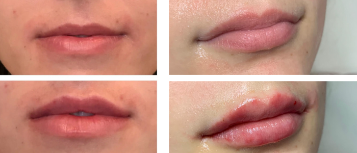 Is 1ml of lip filler a lot?