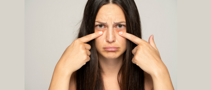 how to remove under eye bags without surgery