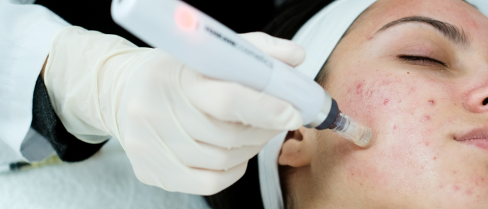 microneedling