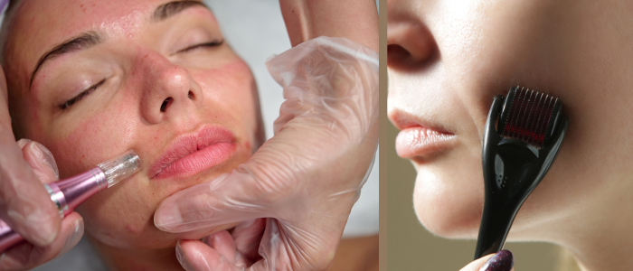 how often should you do microneedling?