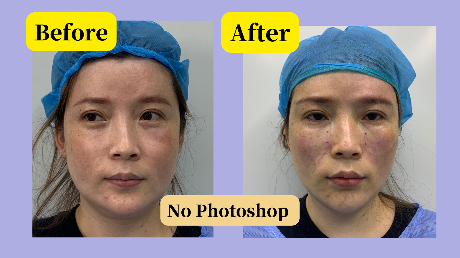 PDO thread lift before and after