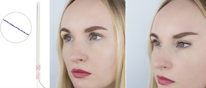 Cat eye thread lift