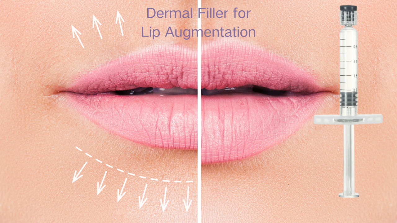 dermal filler for lips