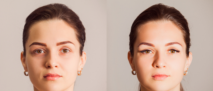 fox eye thread lift costs