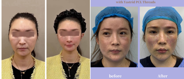 facial contouring by non invasive methods