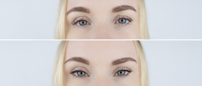 Fox and cat eye thread lift