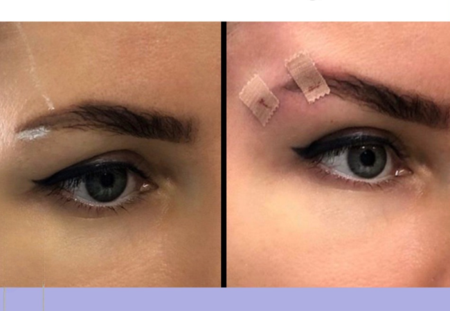cat eye thread lift before and after