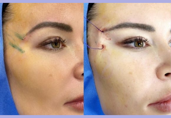 fox eye thread lift before and after