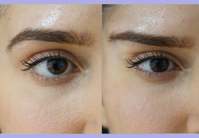fox eye thread lift before and after