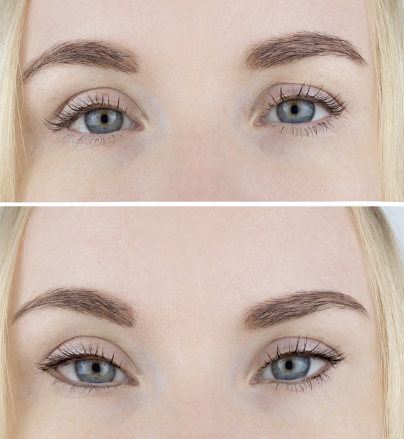 fox eye thread lift