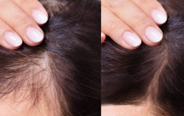 mesotherapy for hair loss