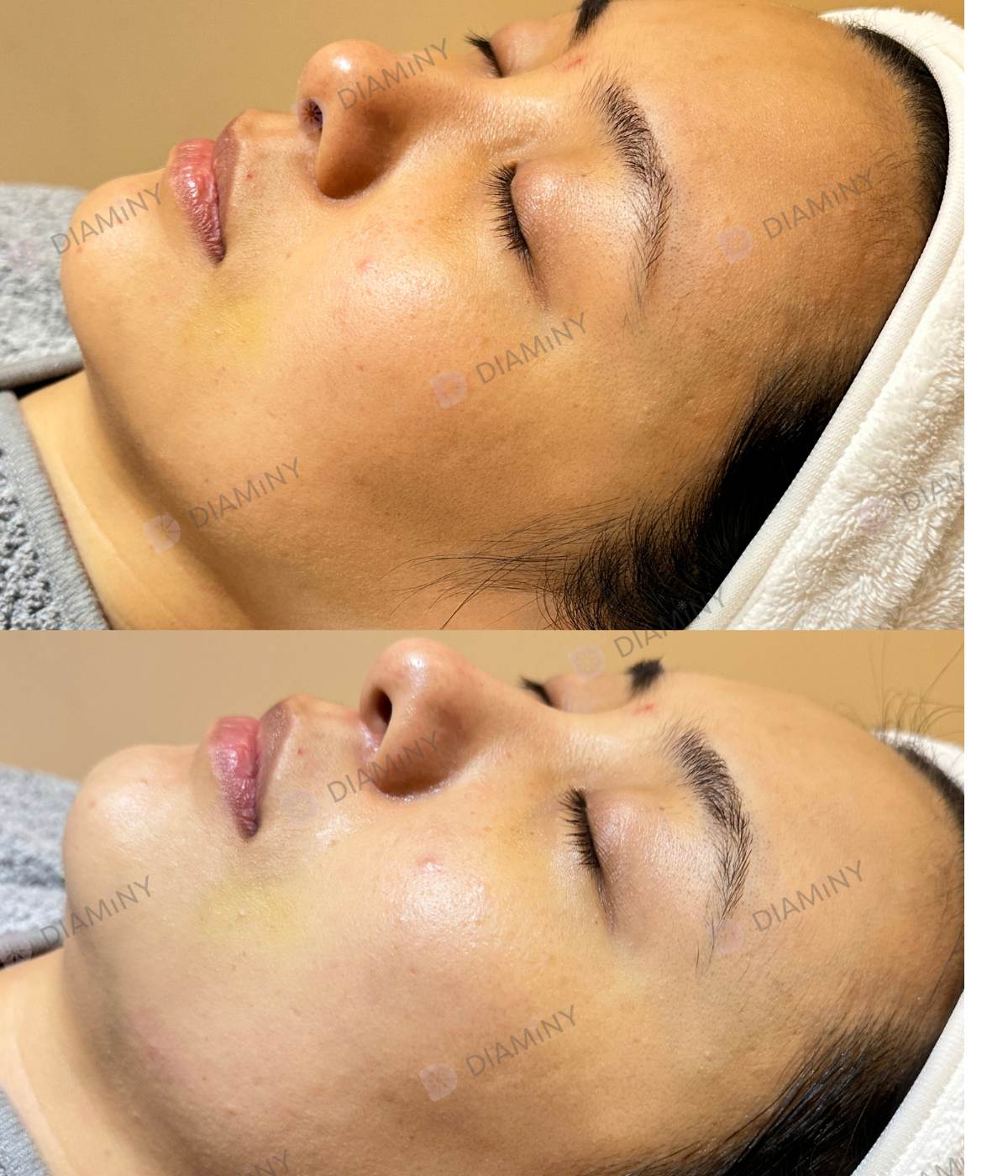 derma pen before and after