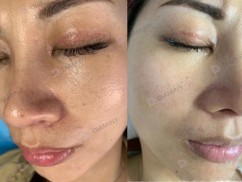 derma pen before and after