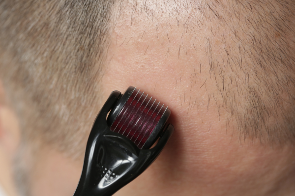 Combining Derma Roller and Minoxidil