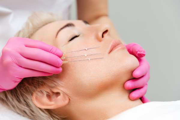 cost of meso thread face lift