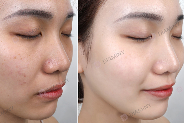 derma roller before and after