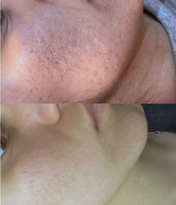 derma roller beefore after