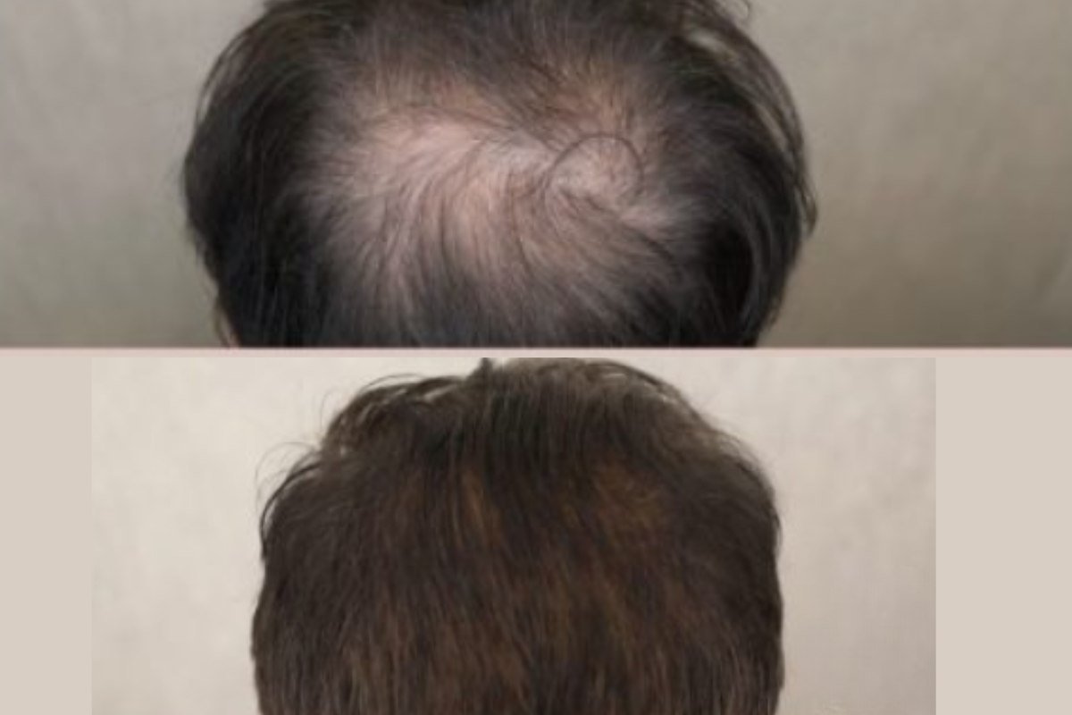 Yastrid derma roller for hair before and after