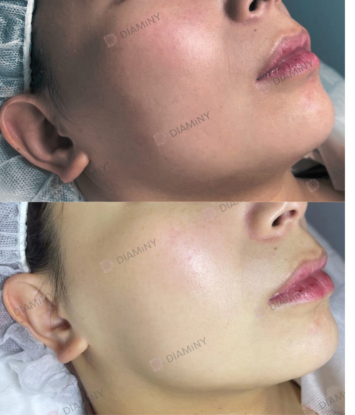 derma pen before and after