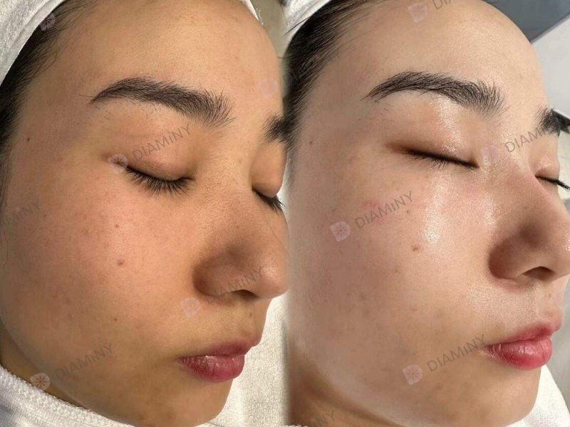 derma pen before and after