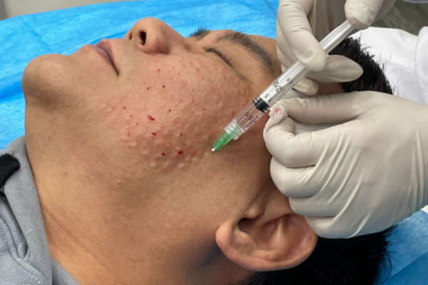 skin booster injection