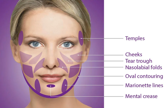 Yastrid dermal filler