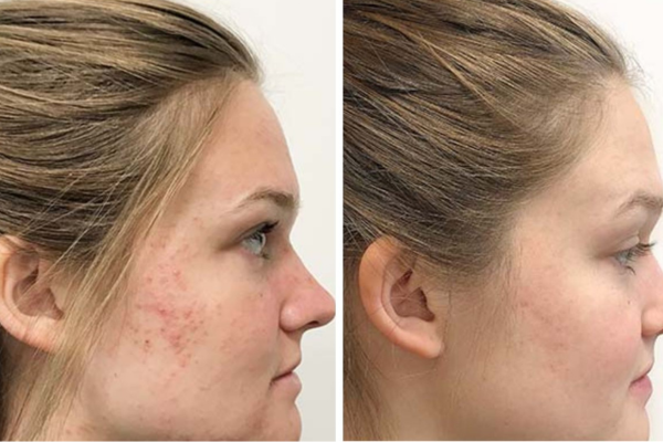 derma roller before and after