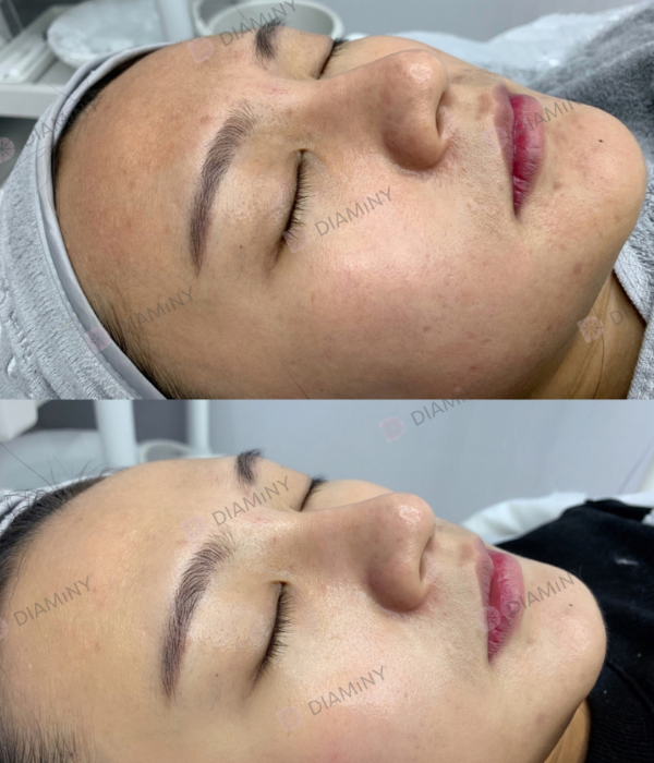 derma roller beefore after