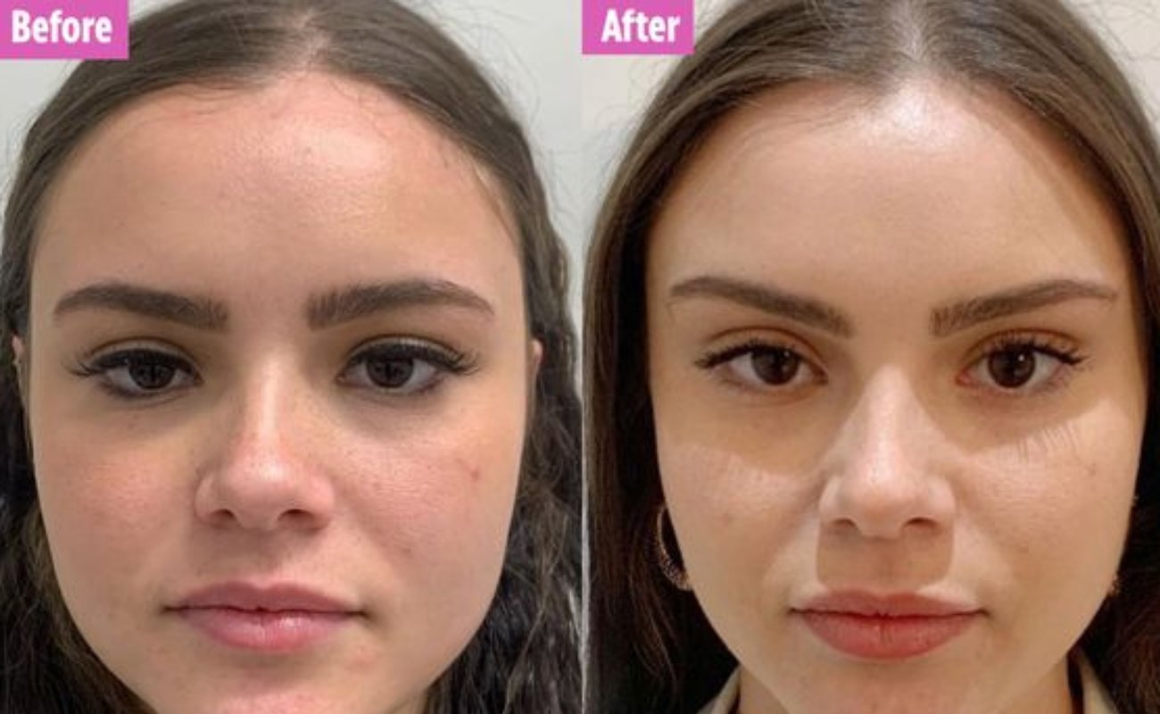 PDO cog thread lift for brows before and after