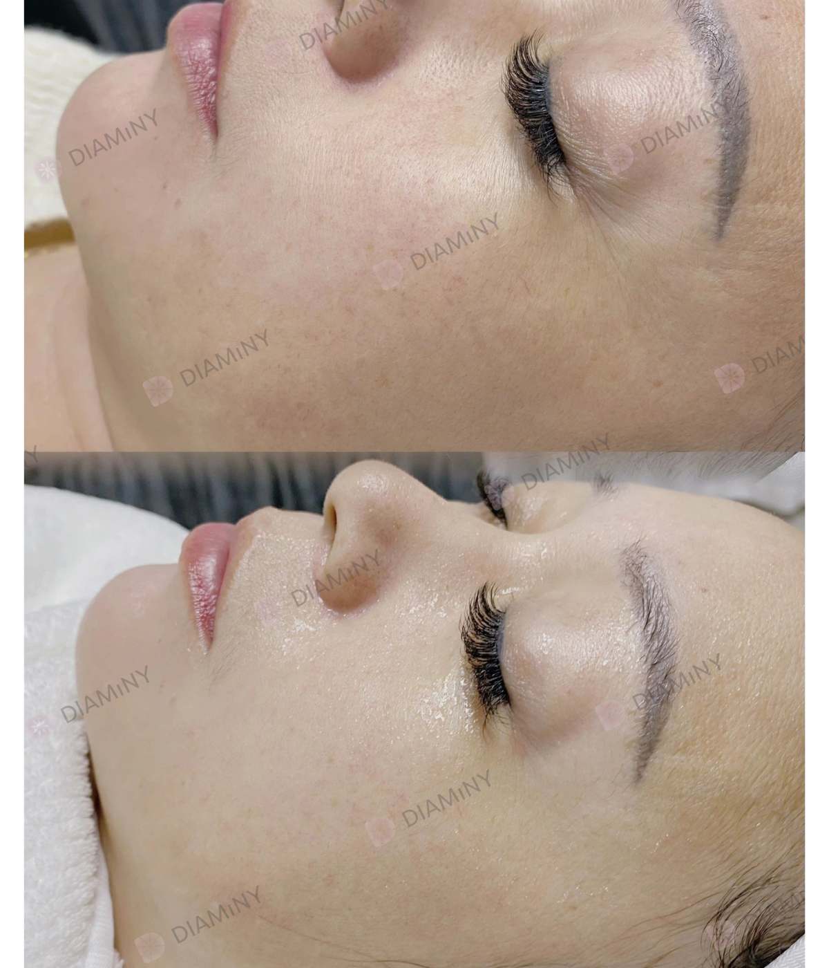 crystal multi needle before and after