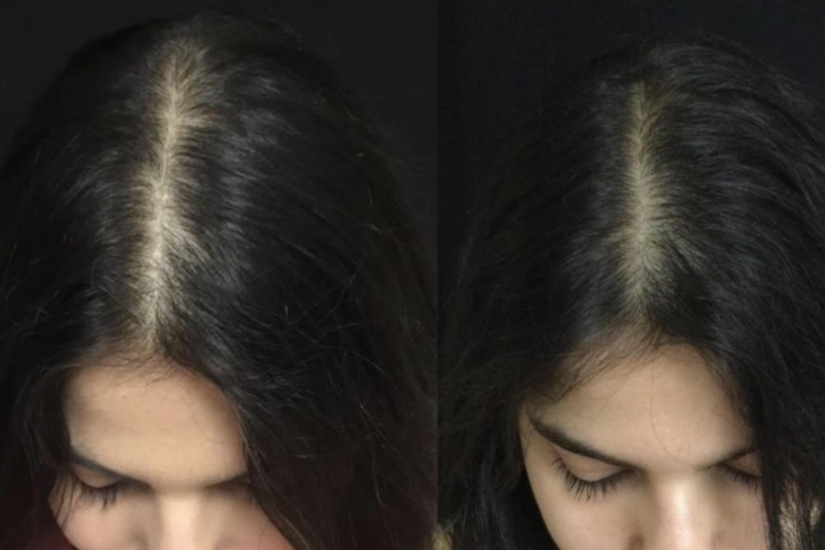 Yastrid derma roller for hair before and after