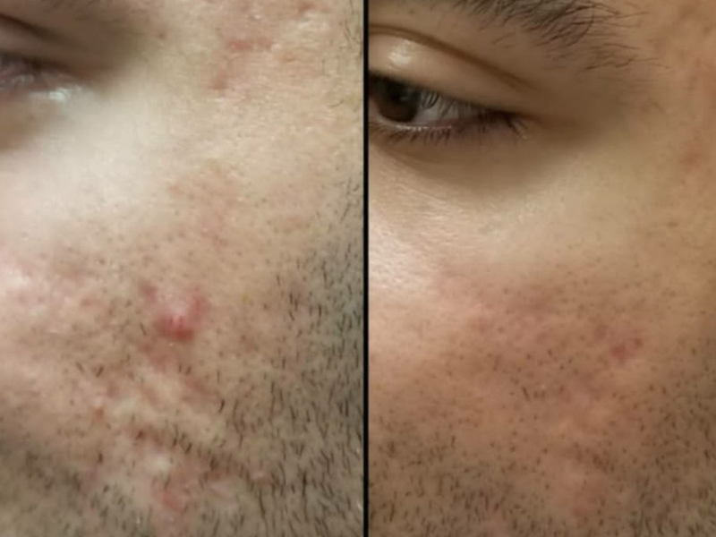 derma pen before and after
