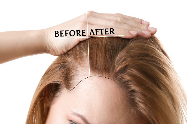 Combining Derma Roller and Minoxidil