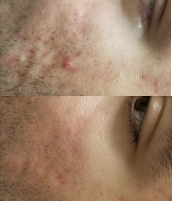 derma roller beefore after