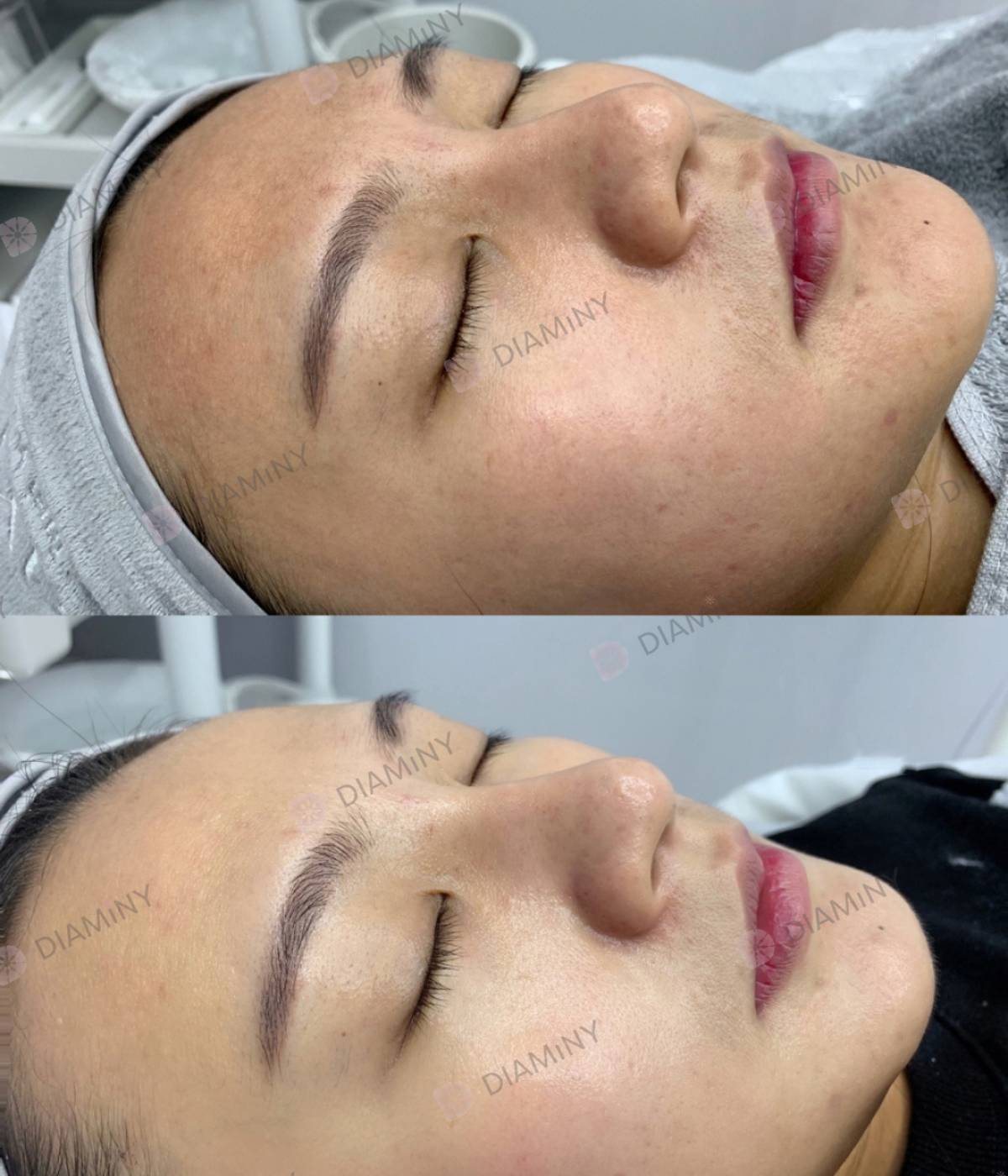 crystal multi needle before and after