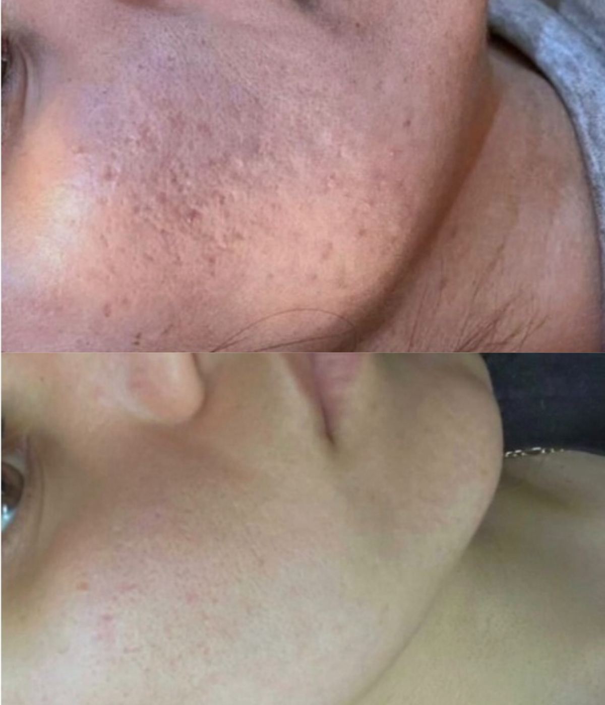 derma pen before and after