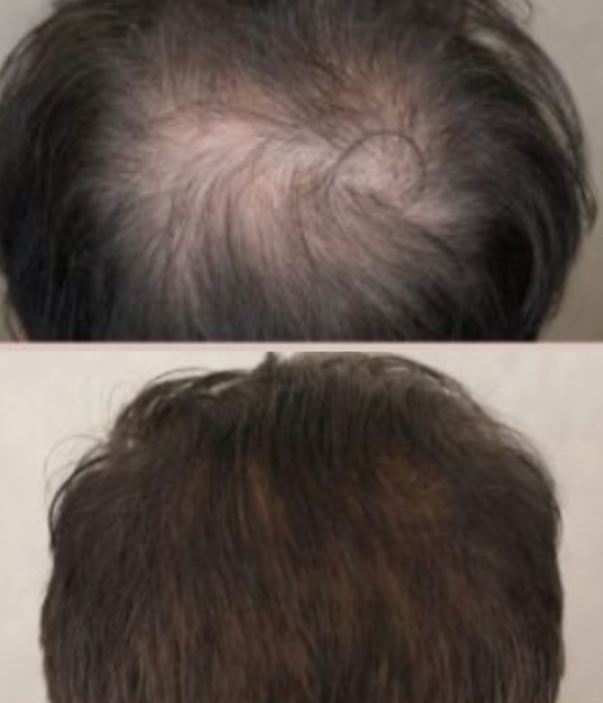 crystal multi needle before and after