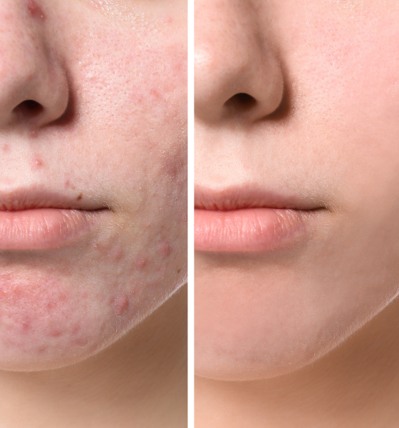 derma roller benefits
